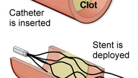 What Are The Symptoms Of Stent Thrombosis at James Mcewen blog