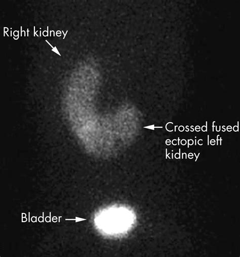 Crossed fused ectopic left kidney | Archives of Disease in Childhood
