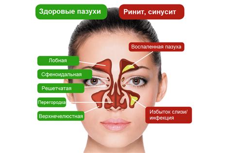 Чем отличается синусит от гайморита