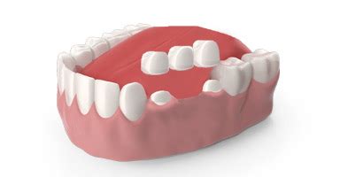 Dental Crowns and Dental Bridges Treatment