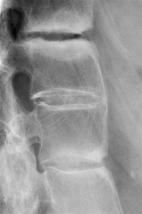 Ankylosing Spondylitis - Ankylosing Spondylitis - MSD Manual ...