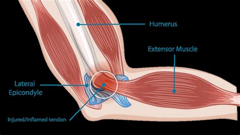 What Are the Symptoms of Tennis Elbow? - Eitan M. Kohan, MD