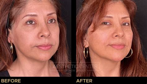 Image result for Cheek Threads