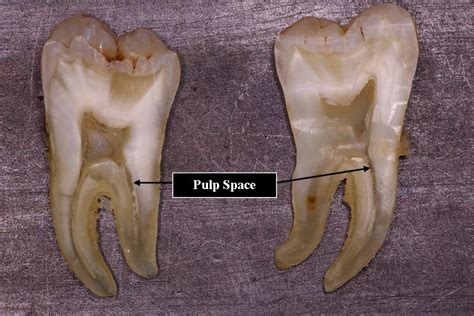 Image result for Pulp Extraction Tooth