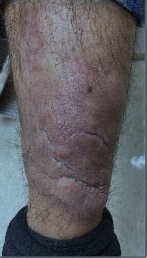 Teprotumumab- a novel treatment for pretibial myxedema