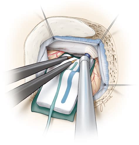 Microvascular Decompression Surgery at Crystal Twyman blog