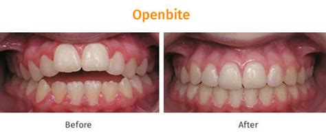Orthodontist in Ahmedabad, Braces Treatment Cost in Ahmedabad