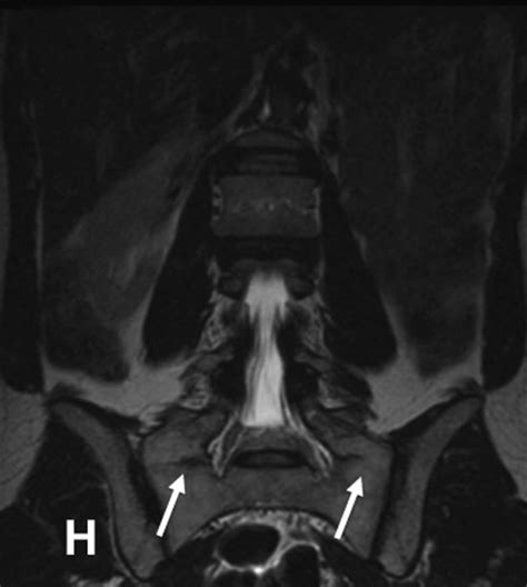 A reliable measurement for identifying a lumbosacral transitional ...