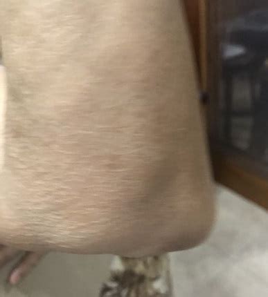 Image result for Elbow Cysts Explode