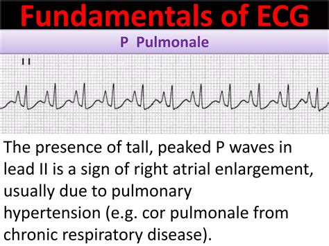 P wave abnormalities in ECG | PPSX