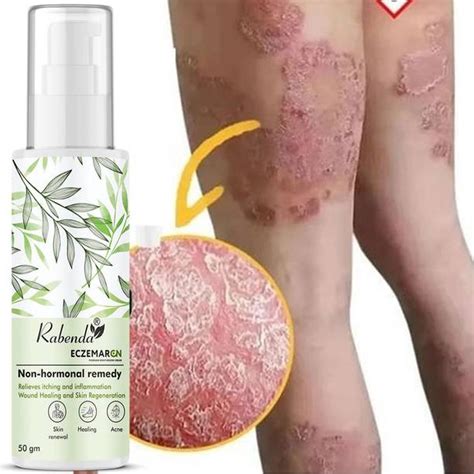 Fungal Infection Cream - Buy Fungal Infection Cream online at Best ...