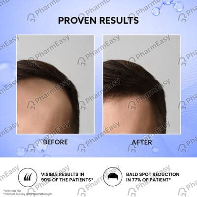 Mintop 10 %W/V Skin Solution (120): Uses, Side Effects, Price & Dosage ...
