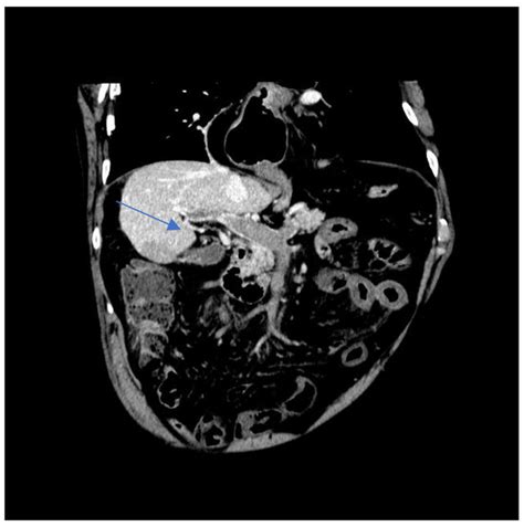 Asymptomatic Intestinal Ischemia Secondary to Thrombosis of the Spleno ...