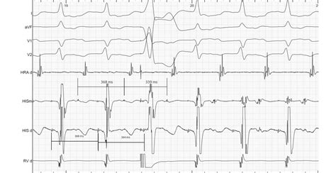 Basic principles of EP maneuvers. Resetting / entrainment