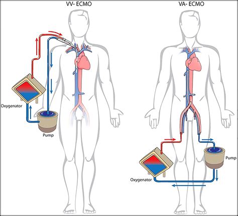 Image result for ECMO Procedure
