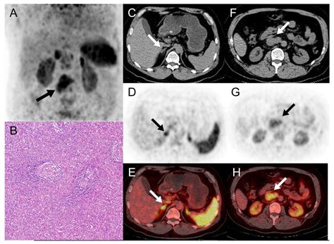 68Ga-DOTATATE and 68Ga-Pentixafor PET/CT in a Patient with Castleman ...
