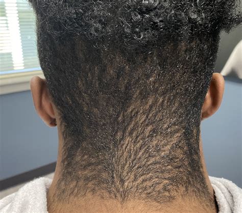 male webbed neck with low hairline Dr Barry Eppley Indianapolis ...