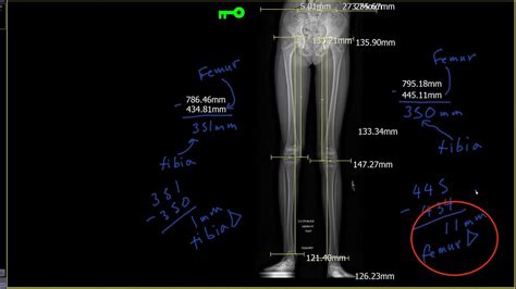 Measure Leg Length Discrepancy 的图像结果