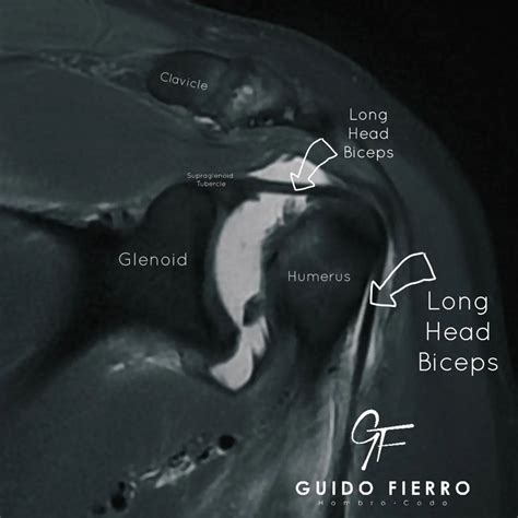 ‏Porción larga del bíceps (Long Head Biceps).‏ | ‏Guido Fierro‏