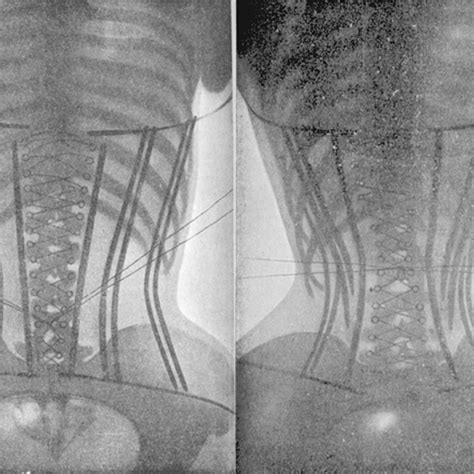 The Smallest Waist In The World: Xray Evidence And Facts