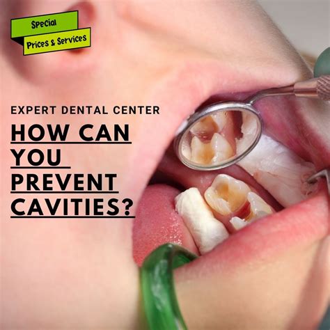 Prevent Cavities, Do You Hate Dental Cavities?