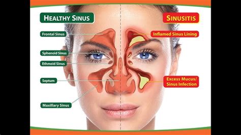 Sinusitis Meaning In Hindi: नासाशोथ, कारण, लक्षण और इलाज - Sinus