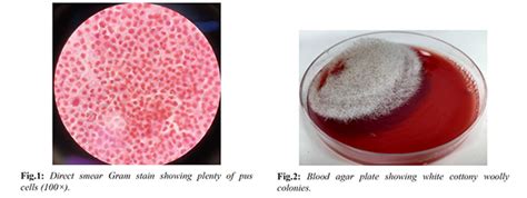 Mucormycosis Involving Maxillary Sinus
