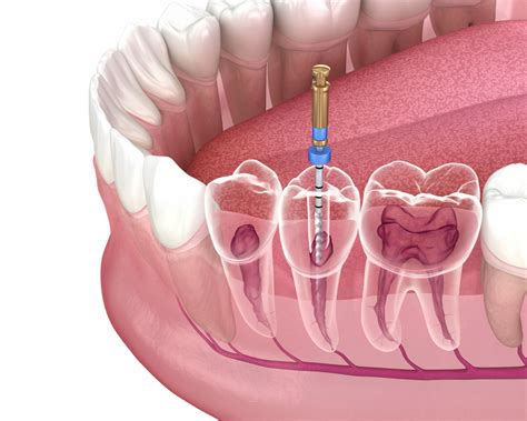 Six Things to Know About Root Canals | Dental Health Associates