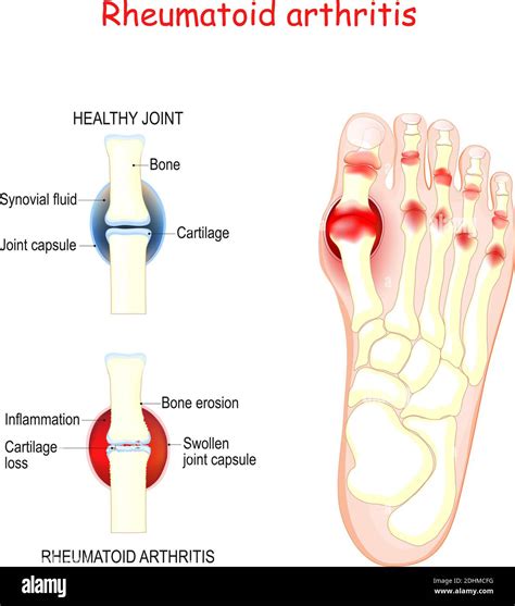 rheumatoid arthritis in joints of human's foot. comparison and difference between healthy bone ...