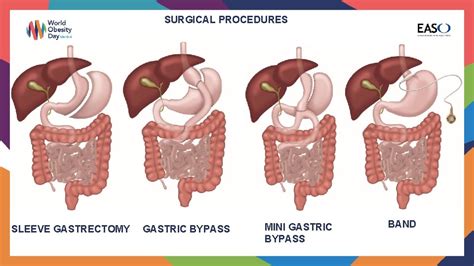 Image result for Colon Polyps Types