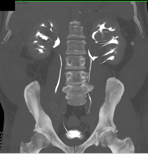 Kuvatulokset haulle parapelvic cyst kidney