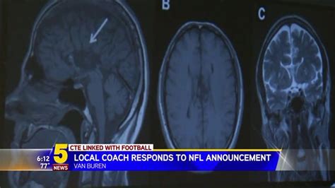 Chris Benoit Brain Scan