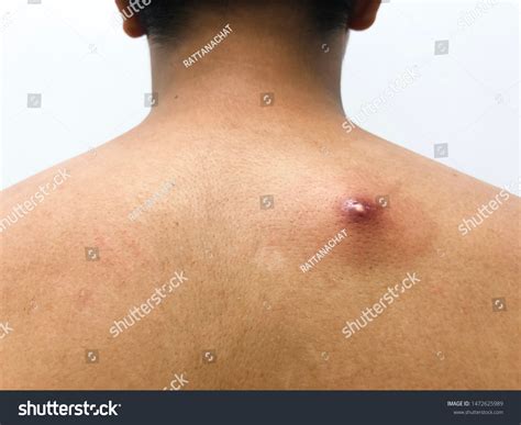 Image result for Giant Abscess Exploding On Back