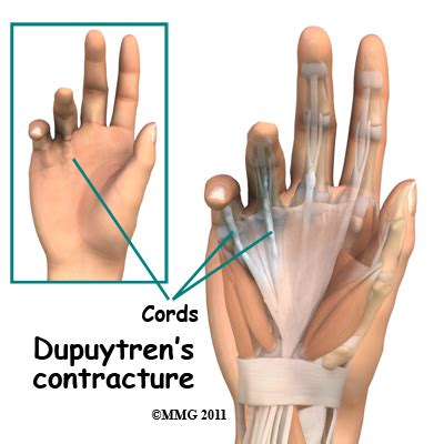 Dupuytren's Contracture | Central Orthopedic Group