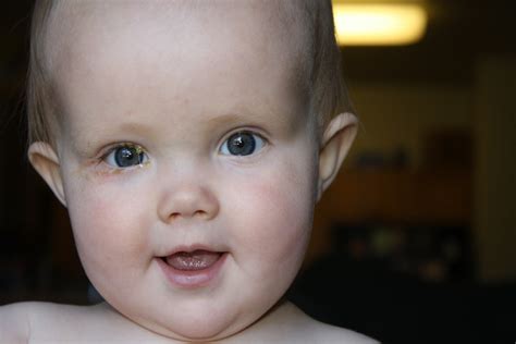 Micah and Rachel: Bye Bye Goopy Eye