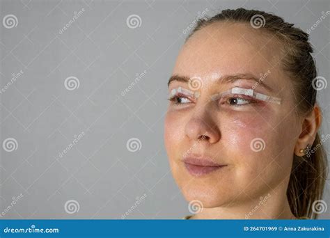 Woman Face after Plastic Surgery, Blepharoplasty Operation, Swelling Eye Bags, Incisions with ...