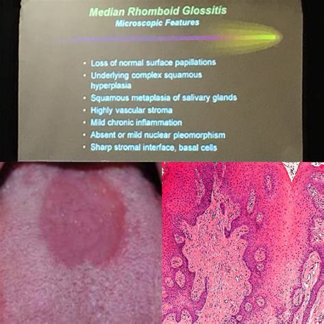Histologie Der Medianen Rhomboidglossitis Median Rhomboid Glossitis