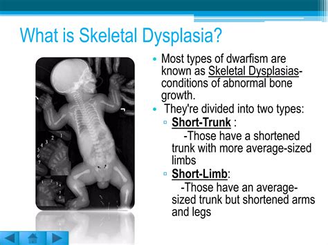 What Is Double Dwarfism