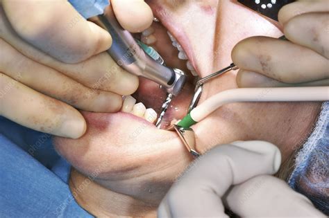 Image result for Tooth Extraction Surgery