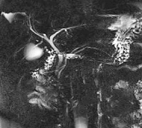 Image result for MRCP Biliary Tree