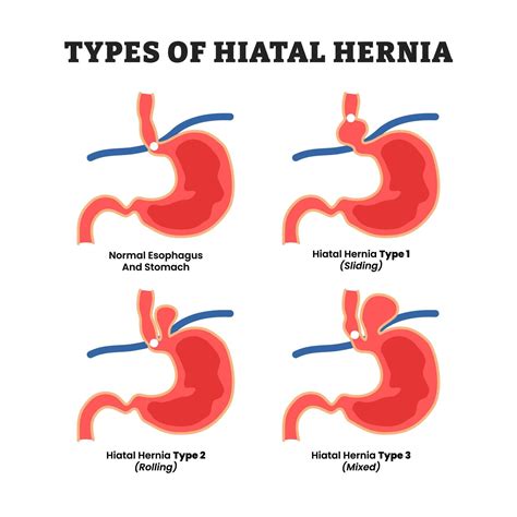 Different types of hiatal hernia types, educational medical poster design healthcare scheme ...