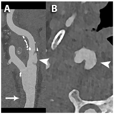 Photon-Counting Computed Tomography Angiography of Carotid Arteries: A ...