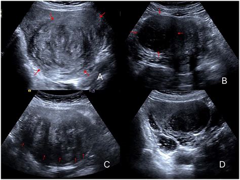 Uterine Fibroids On Ultrasound