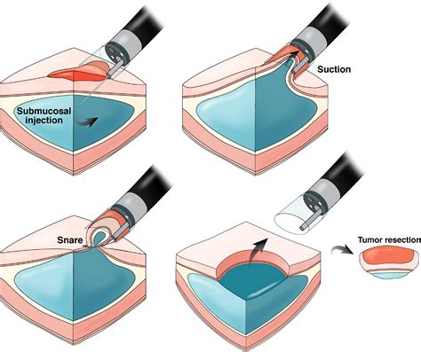 Endoscopic Mucosal Resection: Not Your Father's Polypectomy Anymore ...