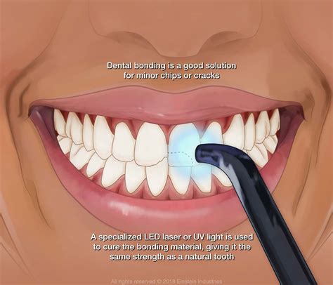 Understanding The Process Of Dental Bonding - RG