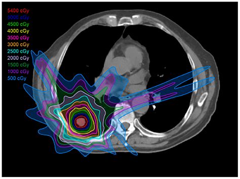 Spectrum of Imaging Patterns of Lung Cancer following Radiation Therapy