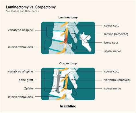 Discectomy And Laminectomy L4 & L5 Lumbar Spine Bilateral Laminectomy