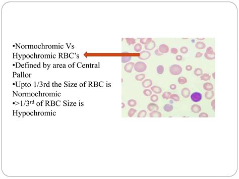 Hypocytic Hypochromic Anemia