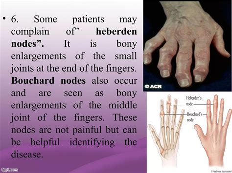 Osteoarthritis | PPT