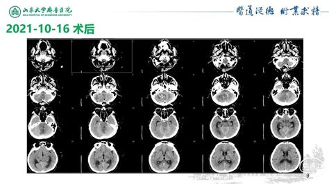 【睿鉴】陆邵佳：采用多模态分析抗精神病药物治疗对首发精神分裂症患者脑结构和功能的影响